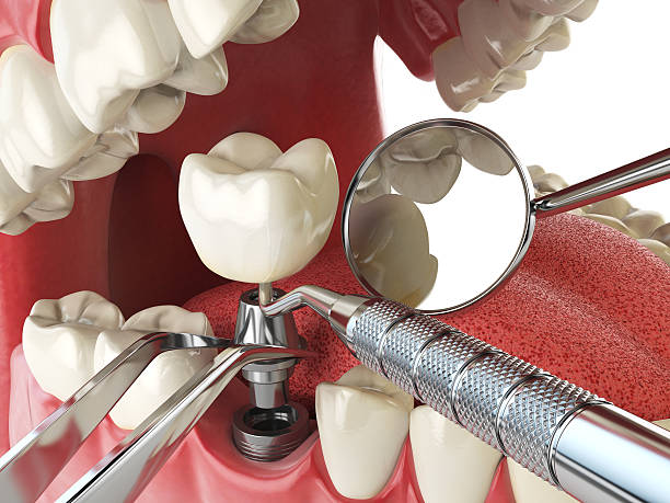 Best Emergency Tooth Extraction in Bushyhead, OK